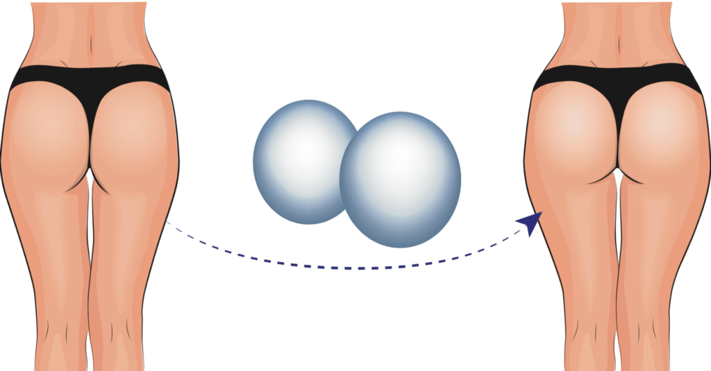 Butt Implants: Exploring Types and Sizes